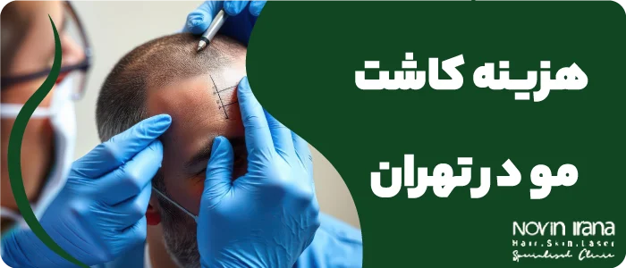 هزینه کاشت مو به روش تکثیر